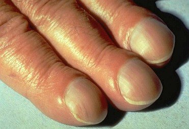 Ногти часовых стеклышек Ногти часовых стеклышек